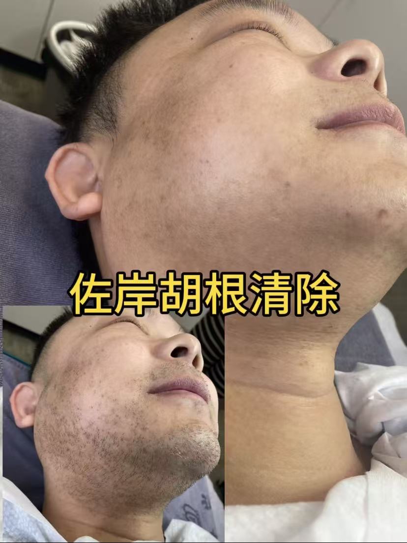 杭州脱毛