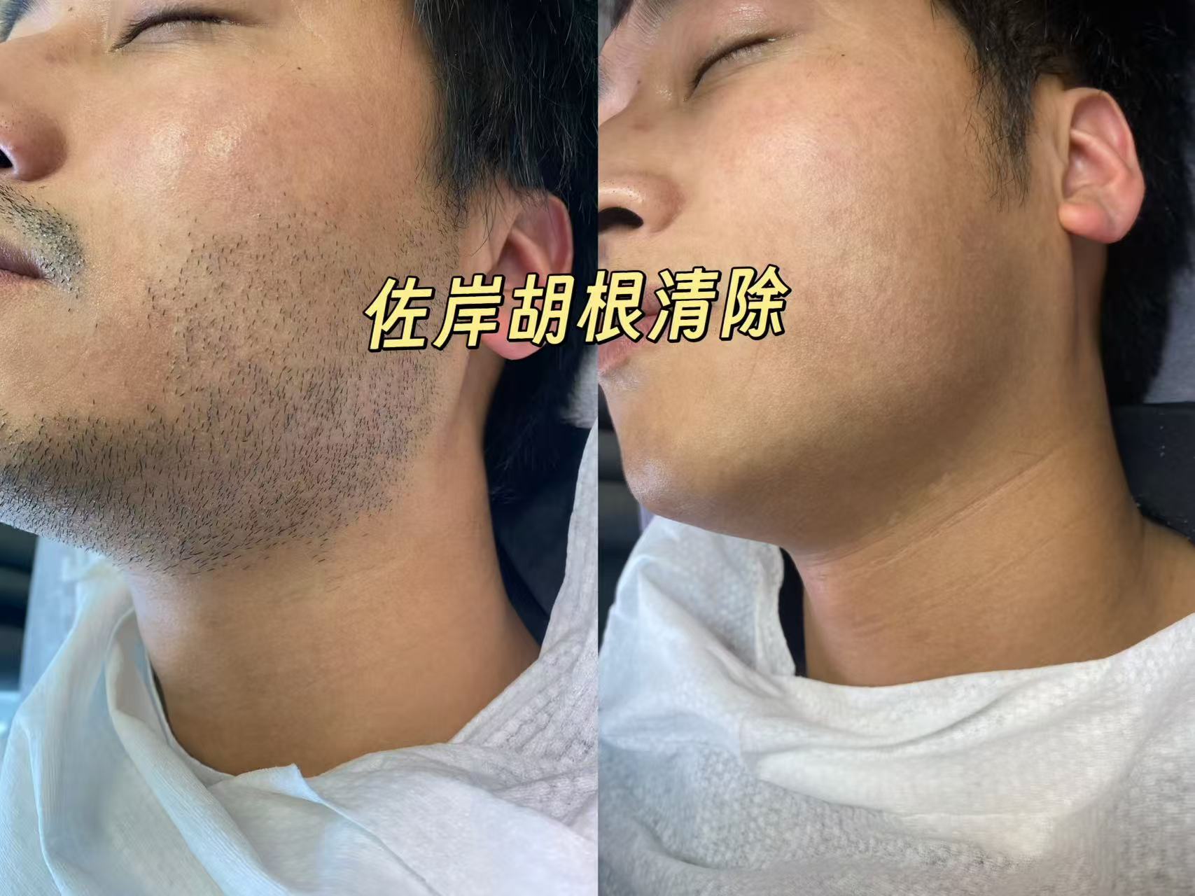 杭州脱胡子